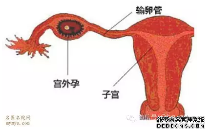 金华明明验出怀孕，子宫却是空的？