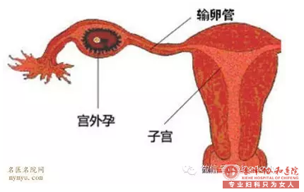 金华当宫外孕不可避免的发生，该怎么办？